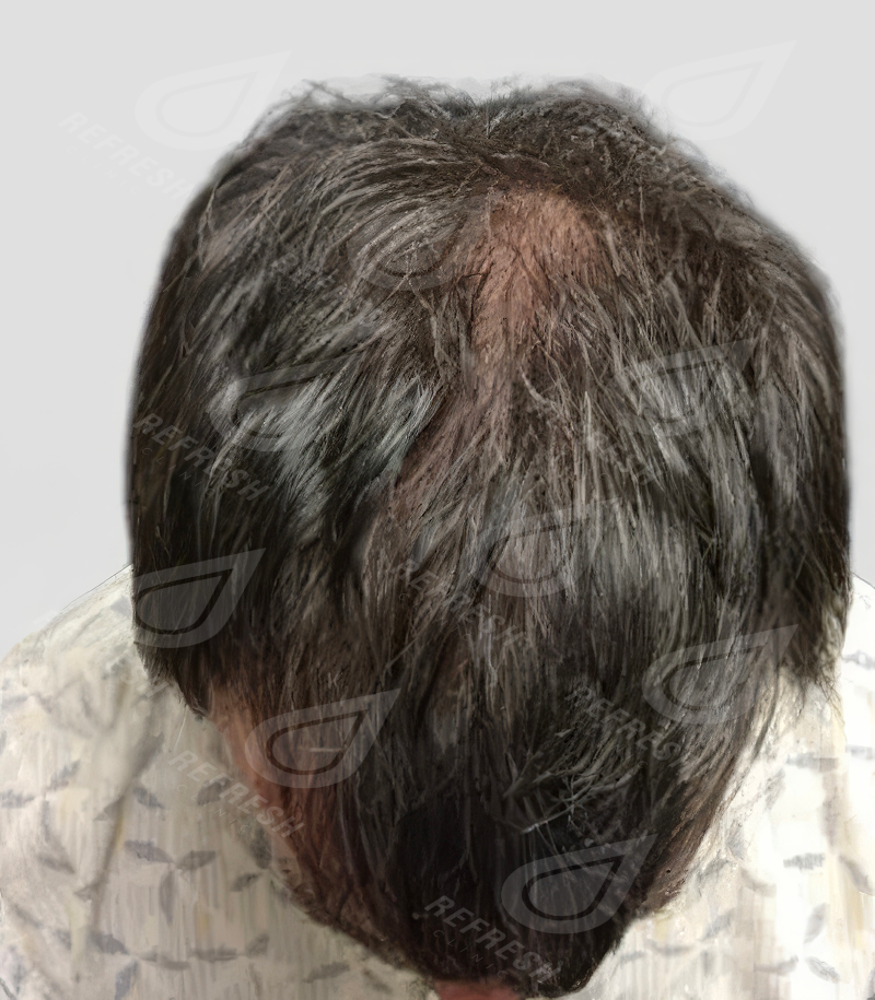 Экзосомы для волос 2