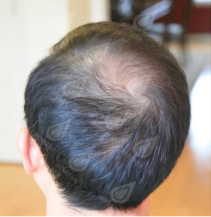 Экзосомы для волос