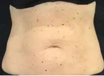 Локальное жиросжигание 1