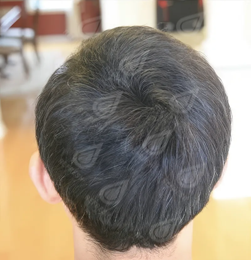 Экзосомы для волос