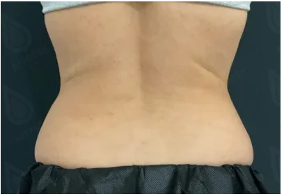 Локальное жиросжигание 2