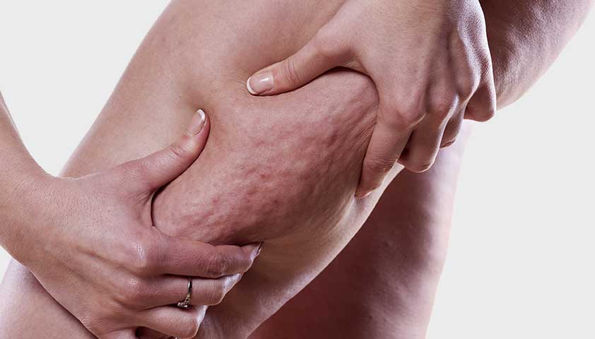 Целлюлит.jpg Целлюлит.jpg