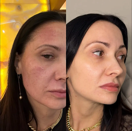 отзыв о процедуре Lumeca