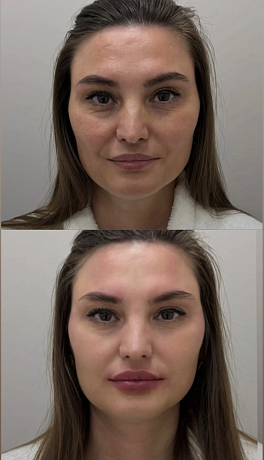 Коррекция мимических морщин в верхней трети лица